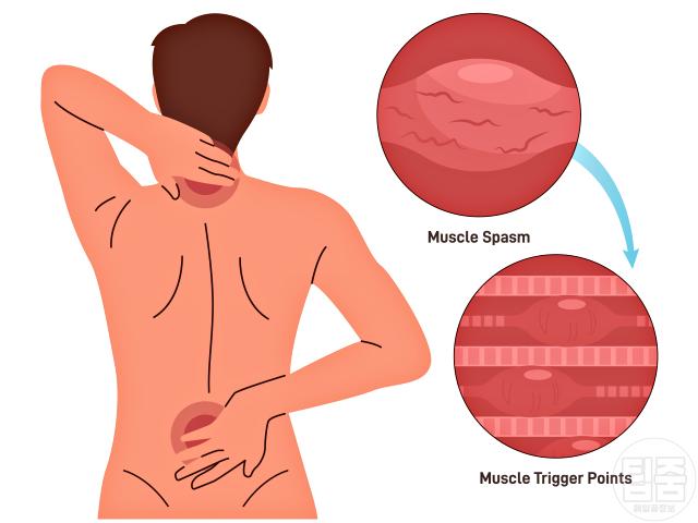 근육 뭉침 원인 신체불균형 통증유발점