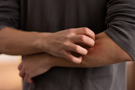 Allergy-to-lacquer