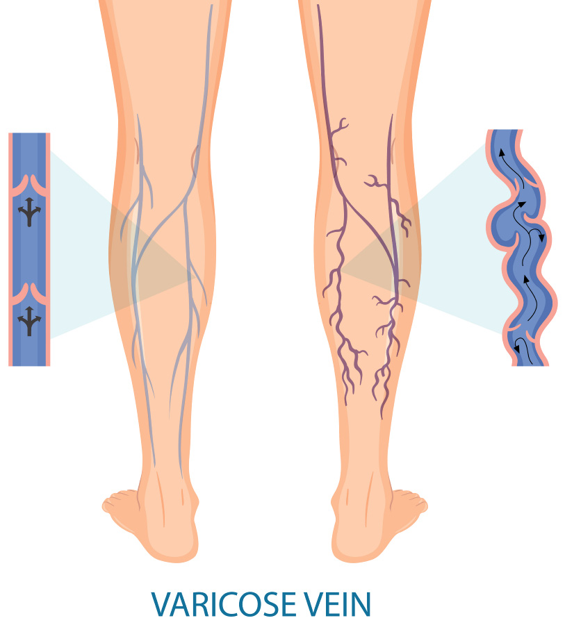 다리에 정상적인 혈관과 비정상적인 하지정맥류 혈관을 비교할 수 있게 그린 이미지 사진