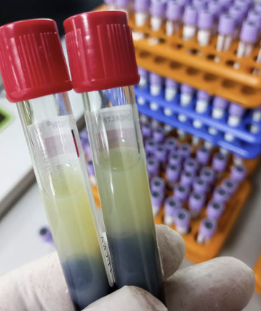 Plasma proteomics 편향