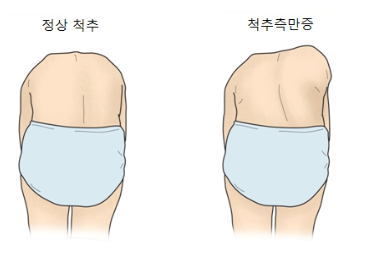 척추측만증