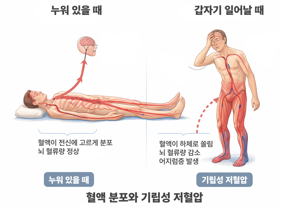 누워 있을 때와 일어났을 때의 혈액 분포 차이를 비교하여, 하체로 혈액이 쏠려 뇌 혈류량이 일시적으로 감소하는 기립성 저혈압 증상 인포그래픽