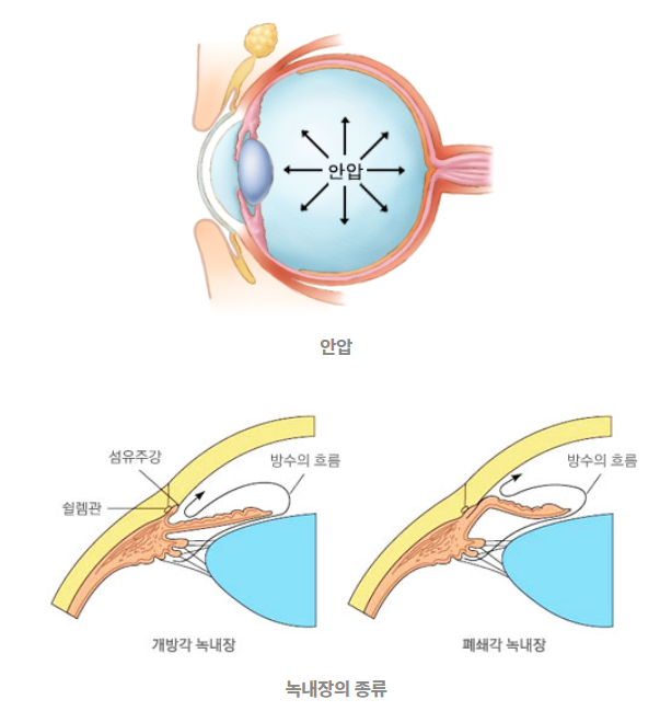 녹내장의 종류