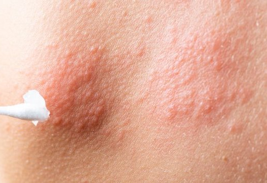 대상포진초기증상