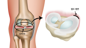 무릎십자인대파열