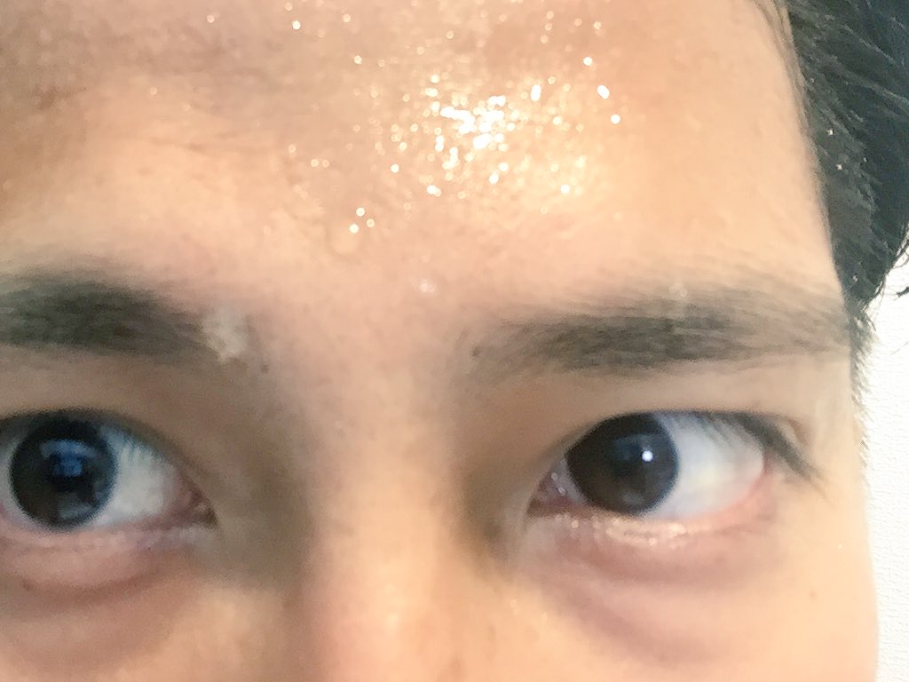 얼굴에 땀이 많이 나는 이유