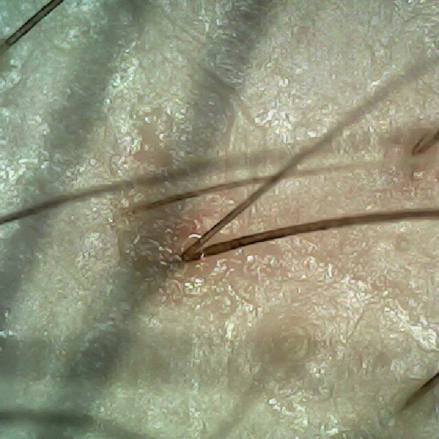 탈모 극복 프로젝트 - 오른쪽 M자 부위 두피 모습이다.