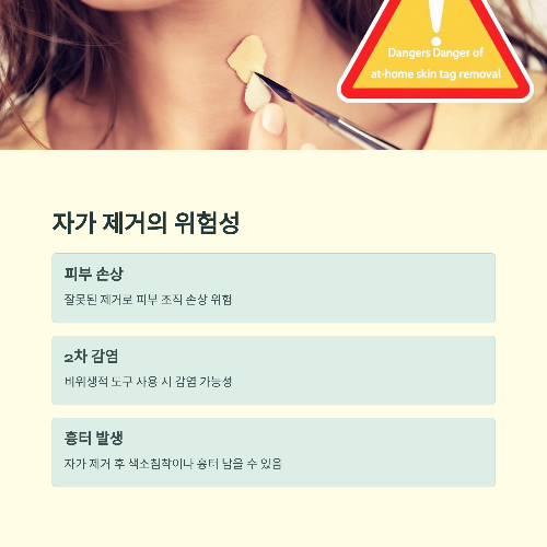 쥐젖 제거, 자가 치료 가능한가요?