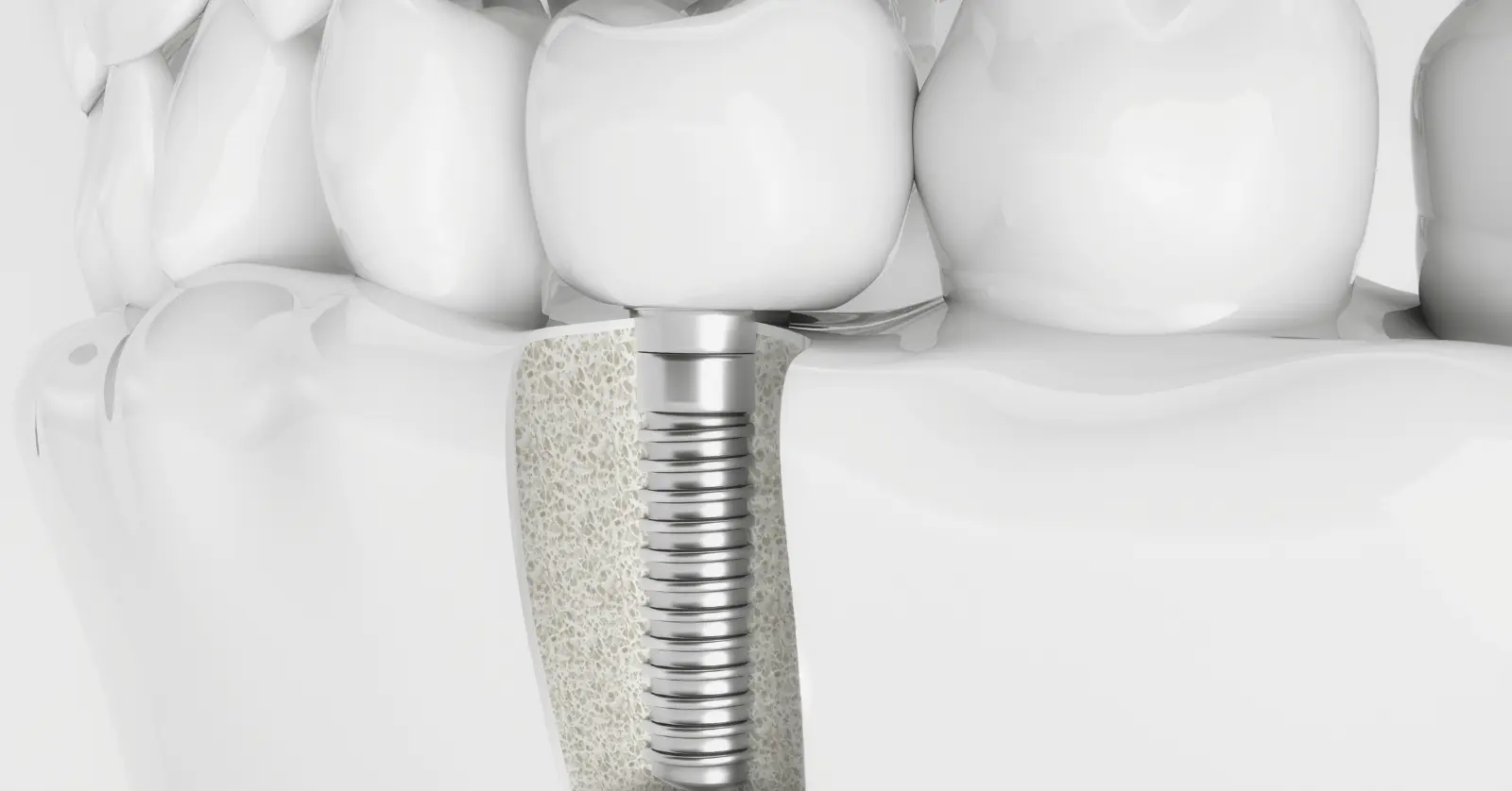 65세이상임플란트정부지원 받는방법