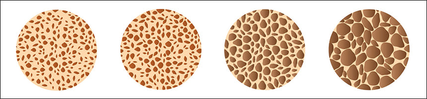 뼈 골밀도 감소 단계