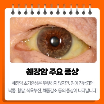 췌장암 초기증상과 진단 지연의 원인 &ndash; 왜 침묵의 암인가