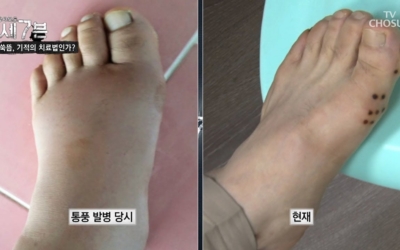 통풍 사진
