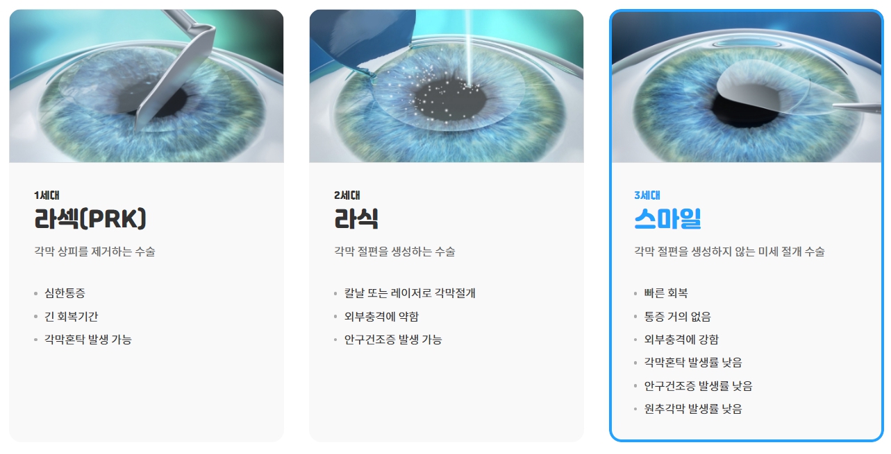 스마일라식 가격 후기 회복기간