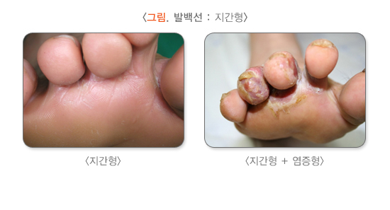 지간형 무좀