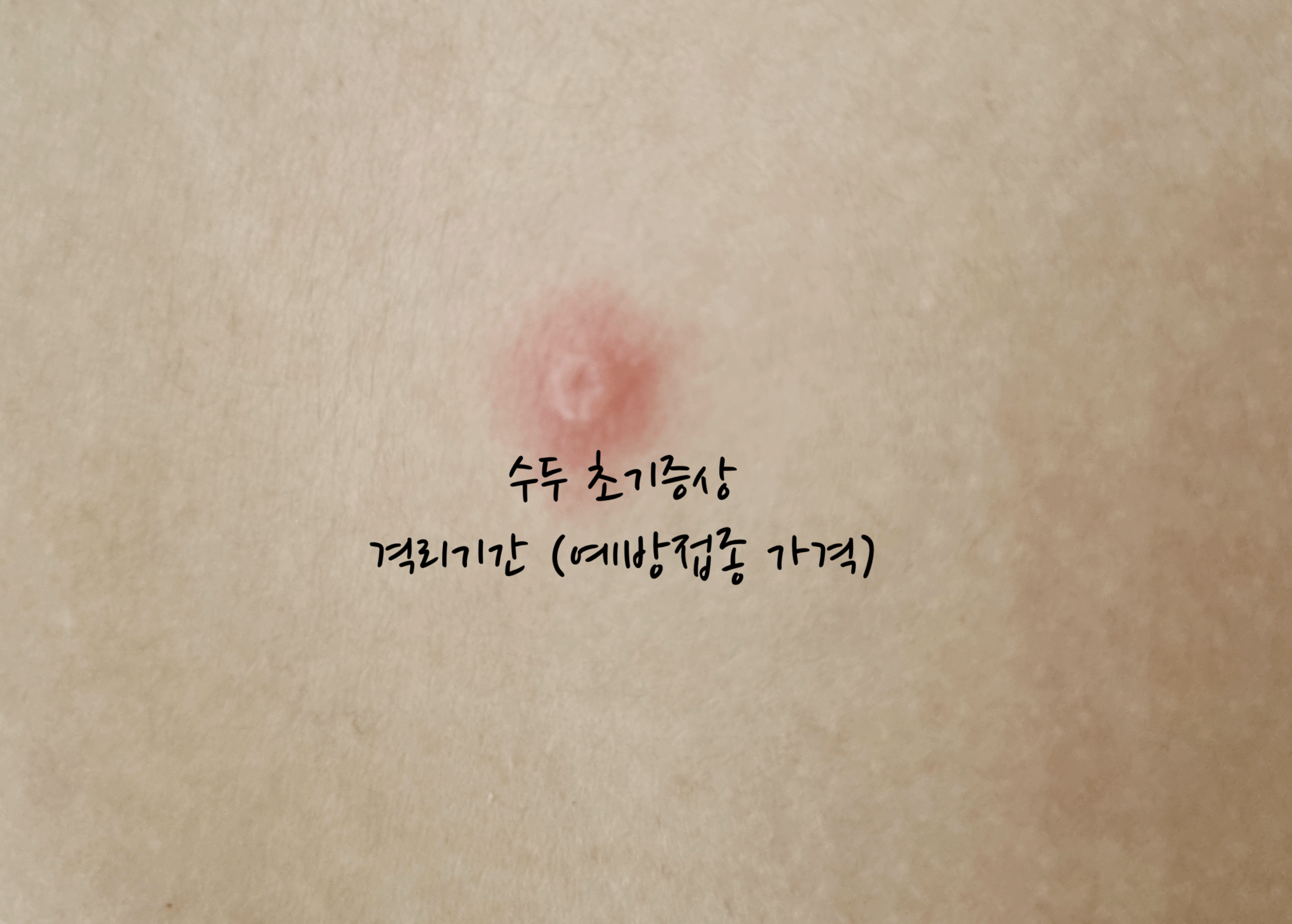 수두 초기증상