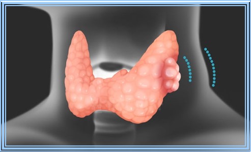 임신 중 갑상선암 7가지 알아둘점