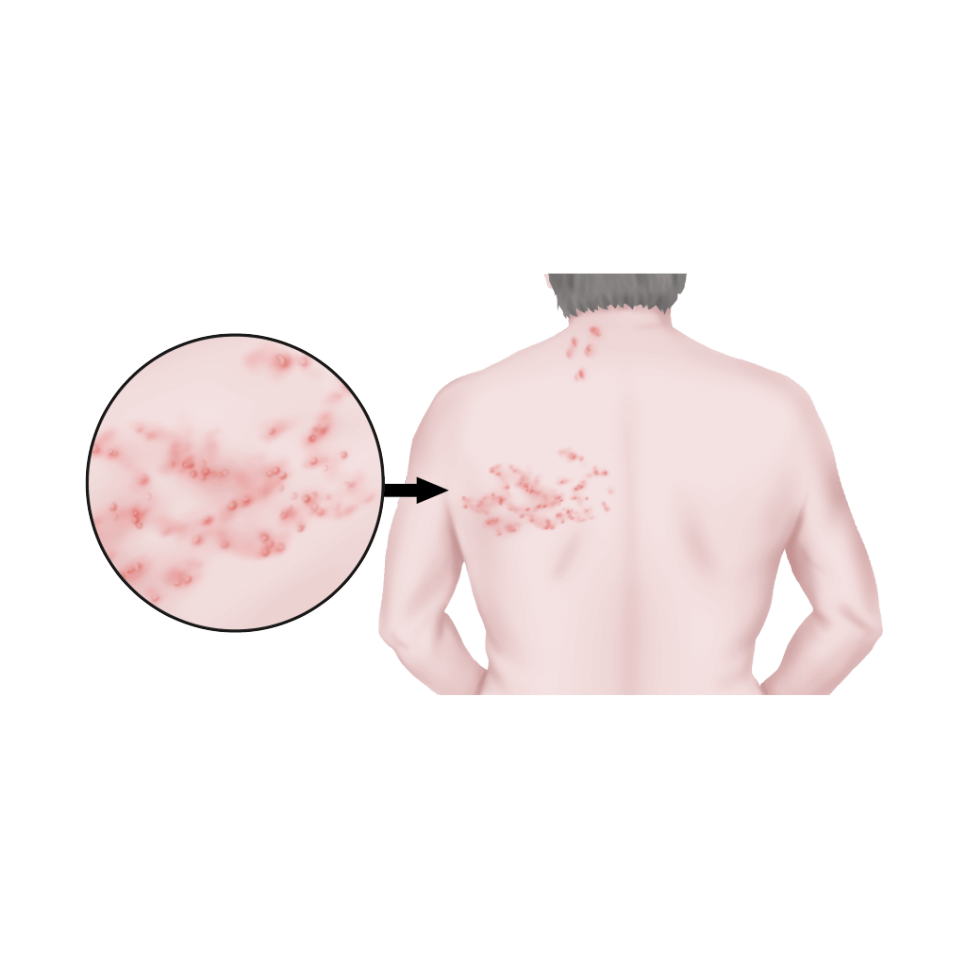 대상포진 피부병변