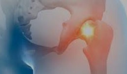 좌골신경통의 원인