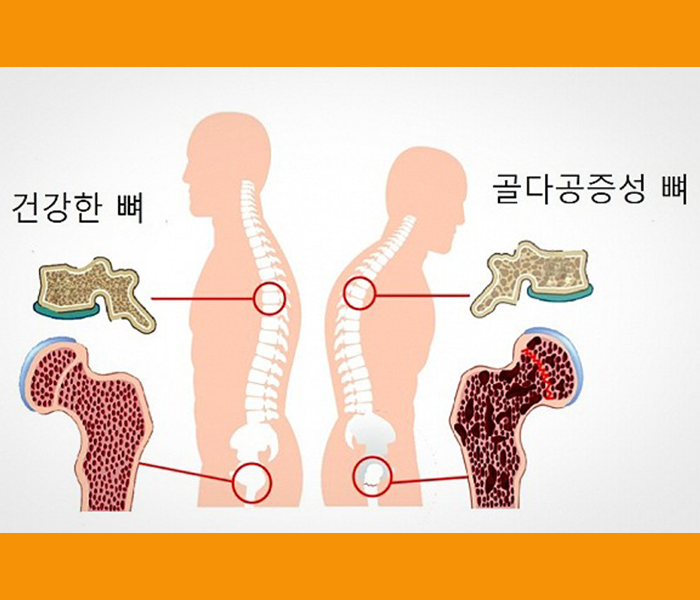 초석잠 효능 - 골다공증 예방
