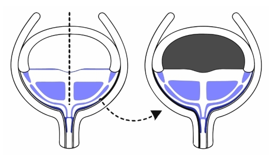 방광암 수술과정