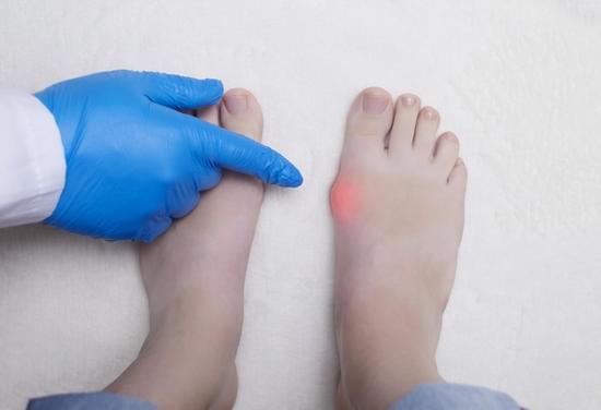 무지외반증(Hallux Valgus) – 엄지발가락 휘는 이유와 치료법