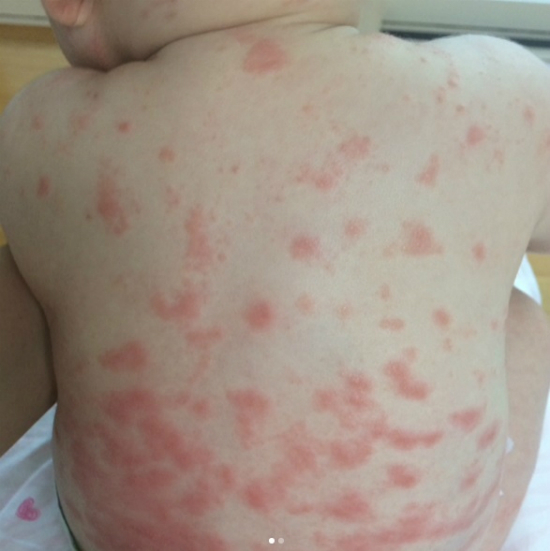 수족구병 증상 및 예방 조치