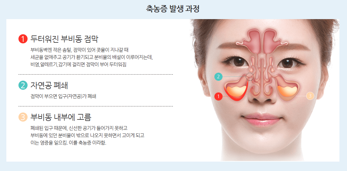 비염