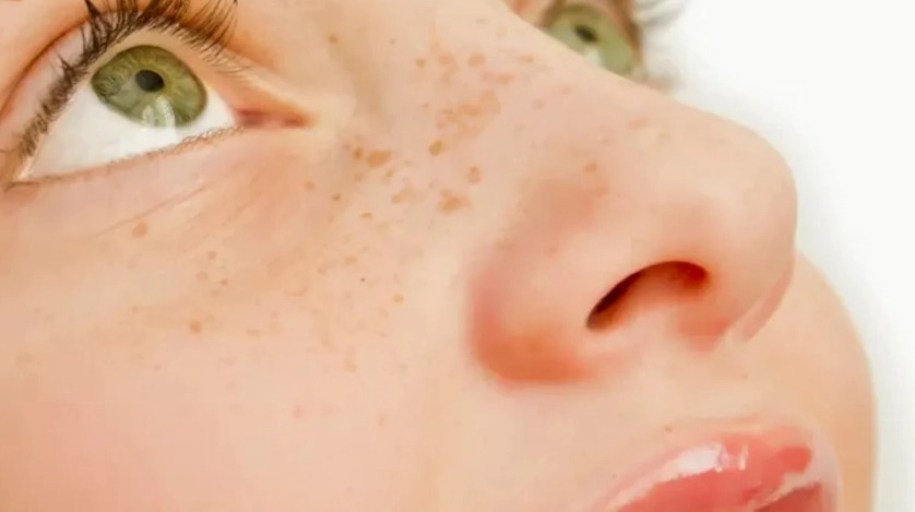 기미 제거 원인