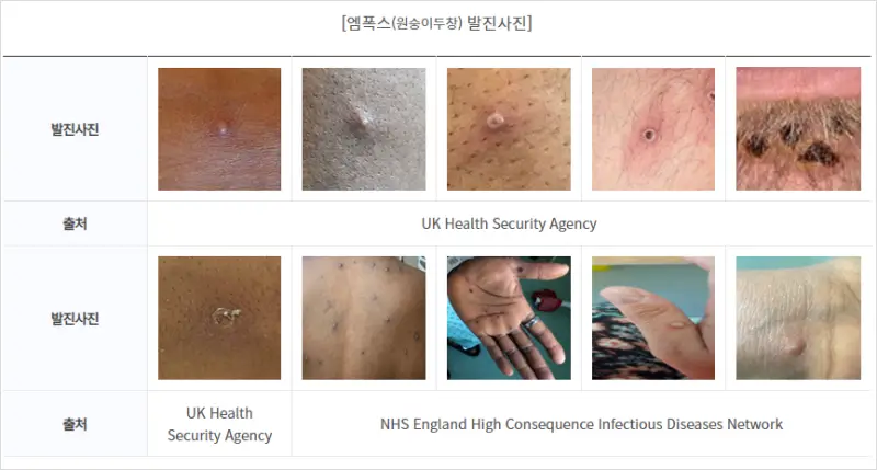 엠폭스 증상 - 출처 질병관리청