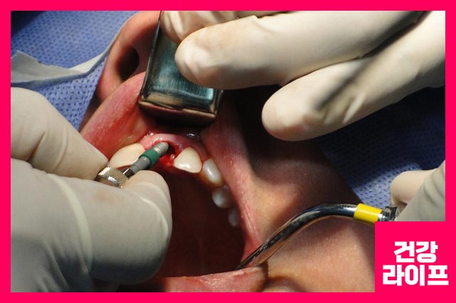 앞니 임플란트 절차