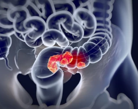 대장암 원인/초기증상/치료법/예방법