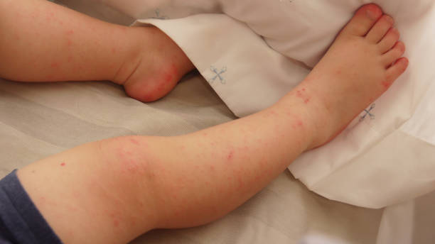 수족구병 초기증상