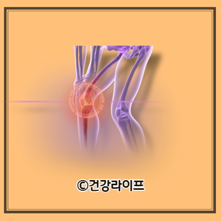 무릎 퇴행성관절염 원인, 증상, 단계별 치료법, 운동법