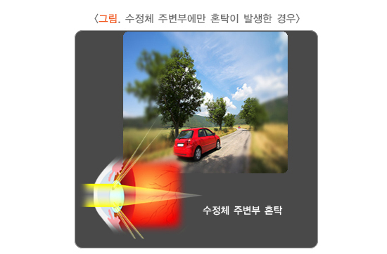 수정체 주변부 혼탁