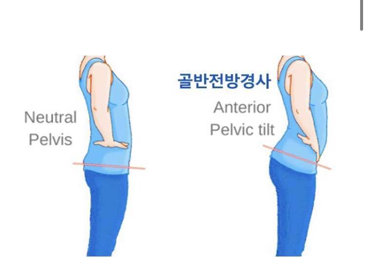 전방경사에 효과 좋은 등산
