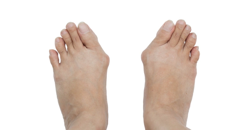 심한 무지외반증