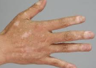 백반증 초기증상 6