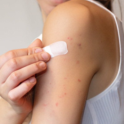 3. 흉터 관리를 위한 연고 추천