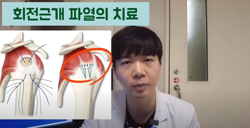 어깨 회전근개파열 6가지 증상 및 수술 비용 (+ 재활운동 질병 코드 원인)
