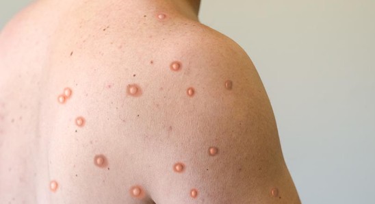 원숭이두창 / 엠폭스 감염경로, 엠폭스 초기증상, 엠폭스 백신