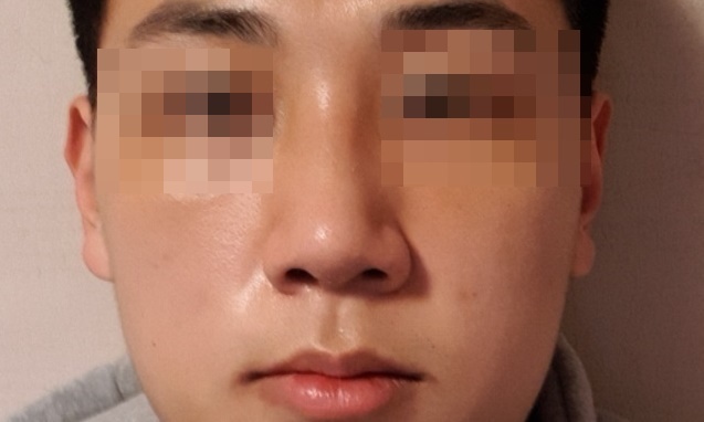 비중격 만곡증 수술 후기