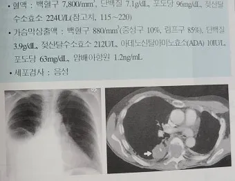 폐에 물이 차는 원인 증상 물참 관리 포인트에 대한 건강정보_21