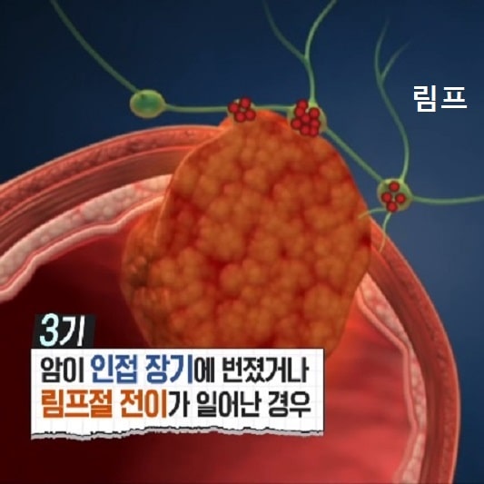 대장암 증상