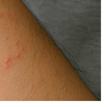 콜린성 두드러기