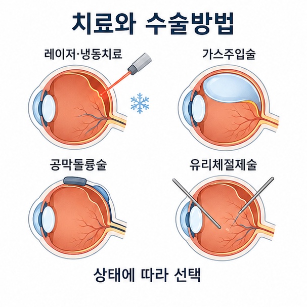 망막 상태에 따라 레이저·냉동치료, 가스주입술, 공막돌륭술, 유리체절제술을 사용할 수 있다는 수술방법 비교 그림