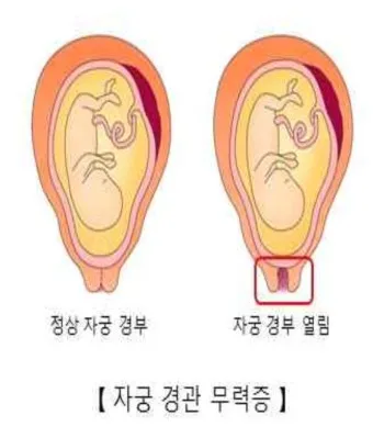 출산 후 자궁수축 기간_7