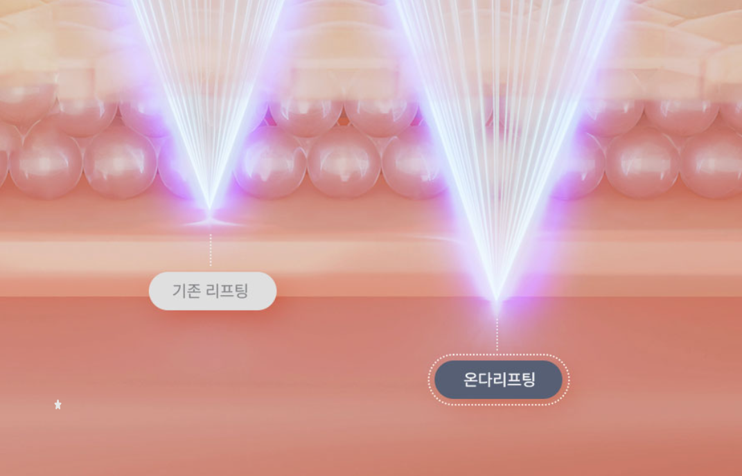 온다리프팅6만줄가격 통증 효과 부작용 이중턱 심부볼 타이트닝 전후 차이 세밀하게 비교 분석하기