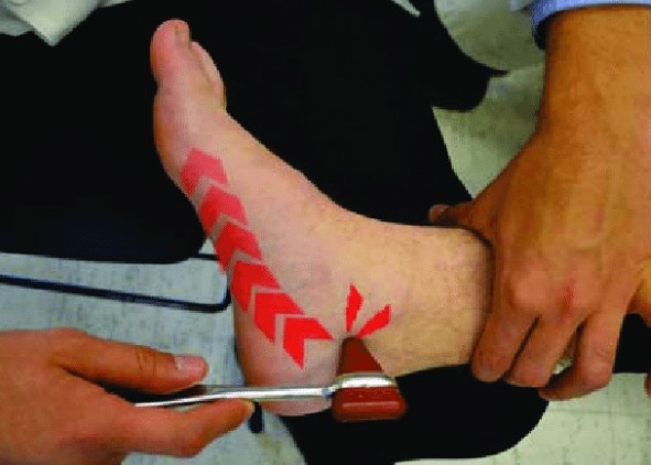 발목저림 발목터널증후군 증상, 원인, 치료, 수술, 예방