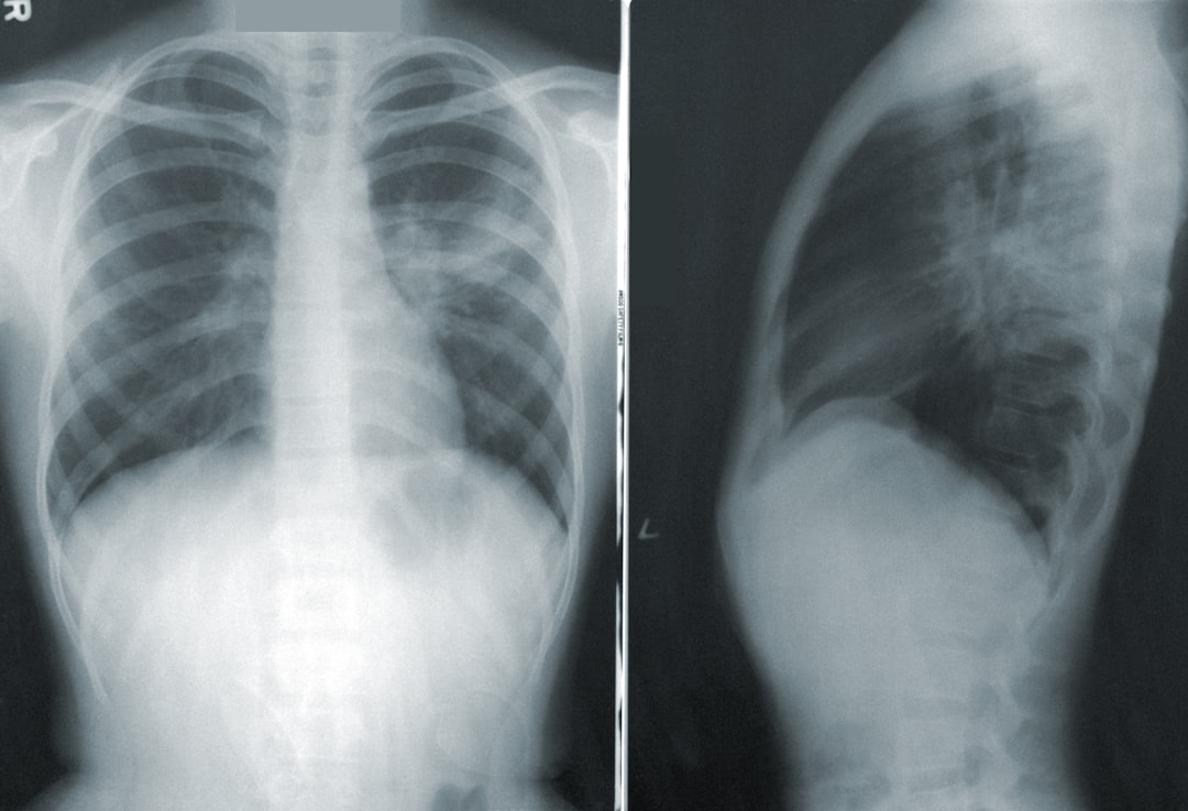 Lung.