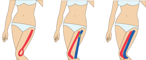 무릎 통증(일반)